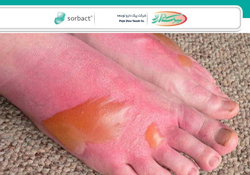 بحران بیپایان نبود مرکز سوختگی در لرستان بحران بیپایان نبود مرکز سوختگی در لرستان